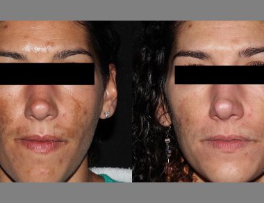 Best Treatment for Pigmentation on Face